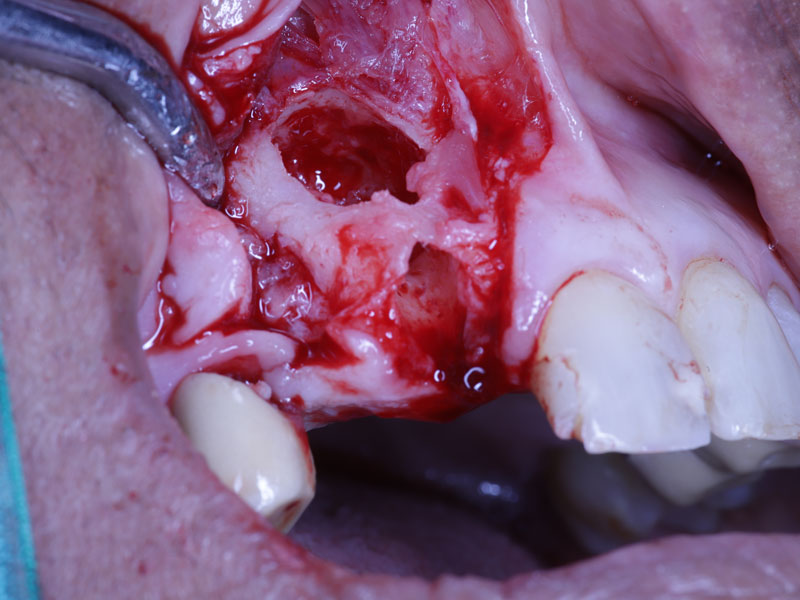 curso-implantologia-extraccion-diente