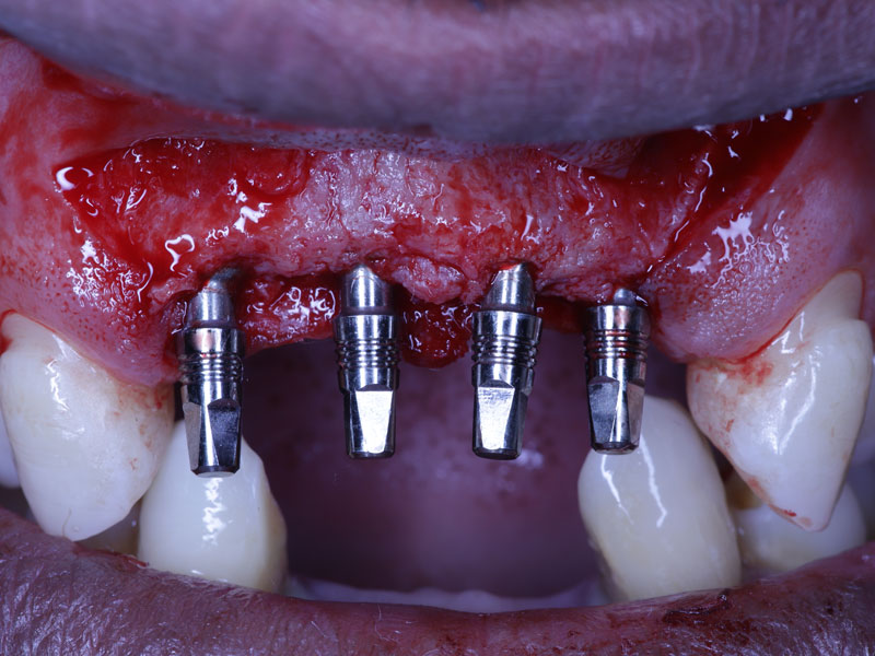 curso-implantologia-implantes-dentales